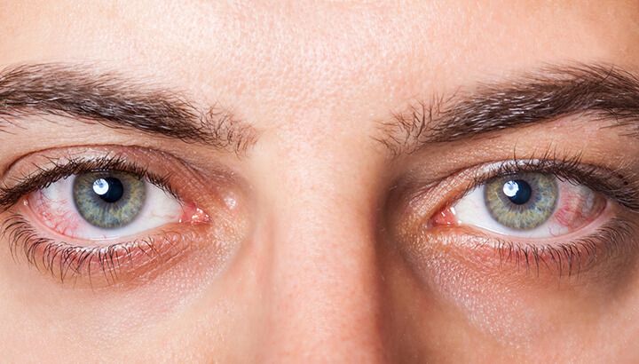 strained eyes